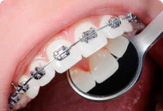 矯正装置が気になる